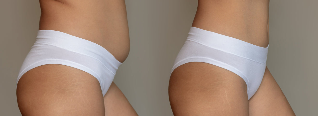 What are Fat Dissolving Injections And Why Our Lipid Dissolve Cream Might Be the Smarter Choice