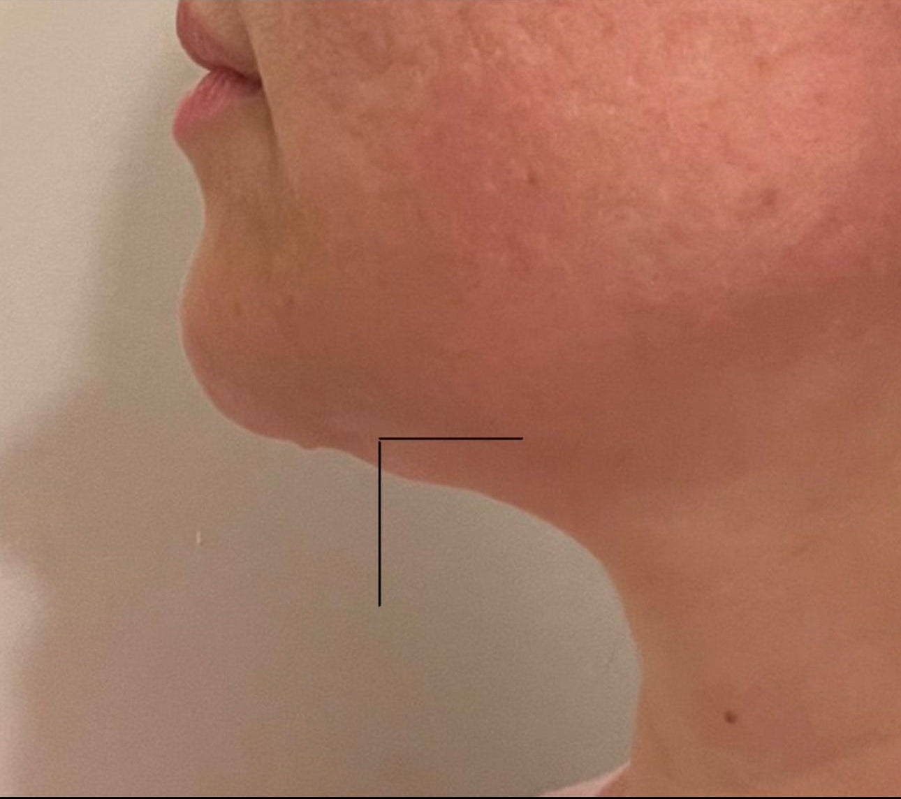 Side-by-side comparison of a person's neck post PCDC. PCDC Procedure  - PCDC Cream. Double Chin. How to get rid of the double chin.