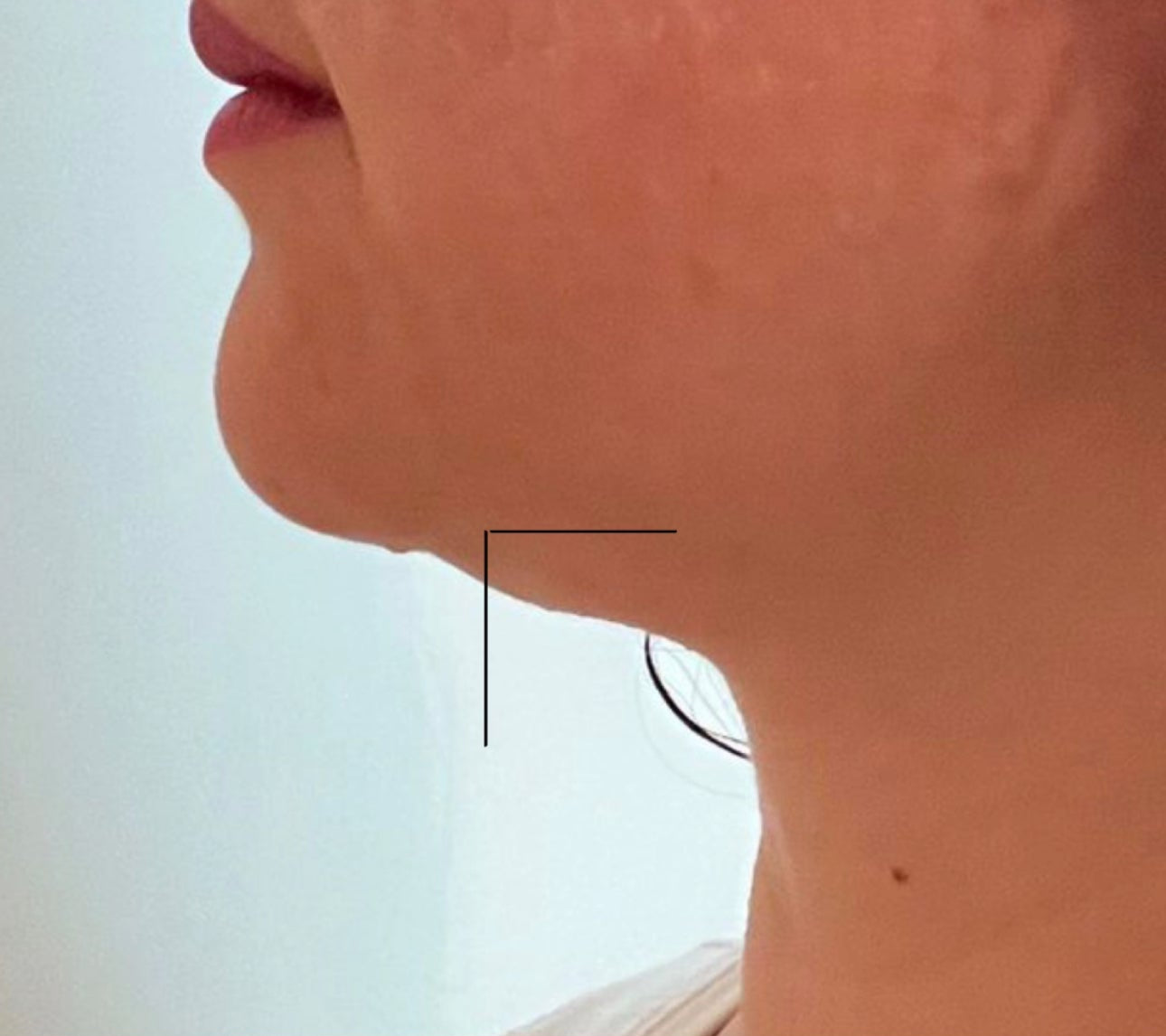 Side-by-side comparison of a person's neck post PCDC. PCDC Procedure  - PCDC Cream. Double Chin. How to get rid of the double chin.