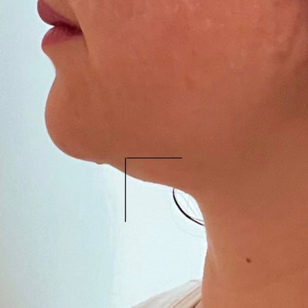 Side-by-side comparison of a person's neck post PCDC. PCDC Procedure  - PCDC Cream. Double Chin. How to get rid of the double chin. 
