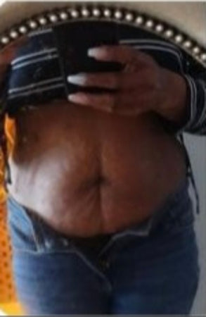Before and after fat removal and abs