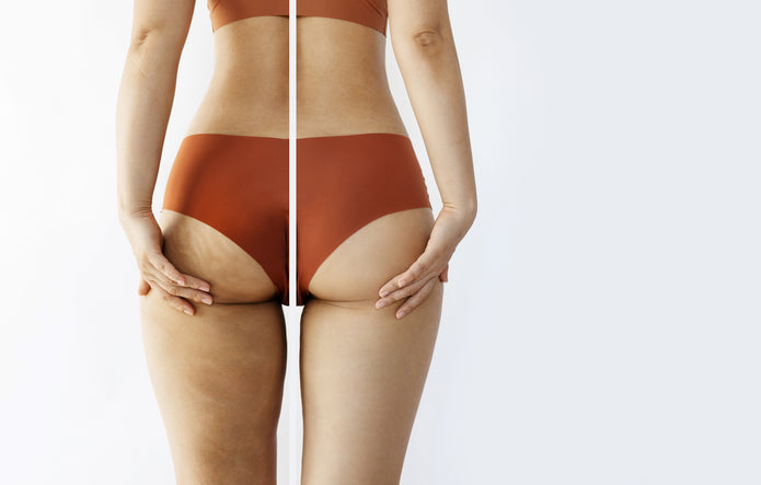 Cellulite No More