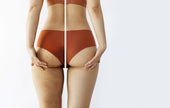 Cellulite No More
