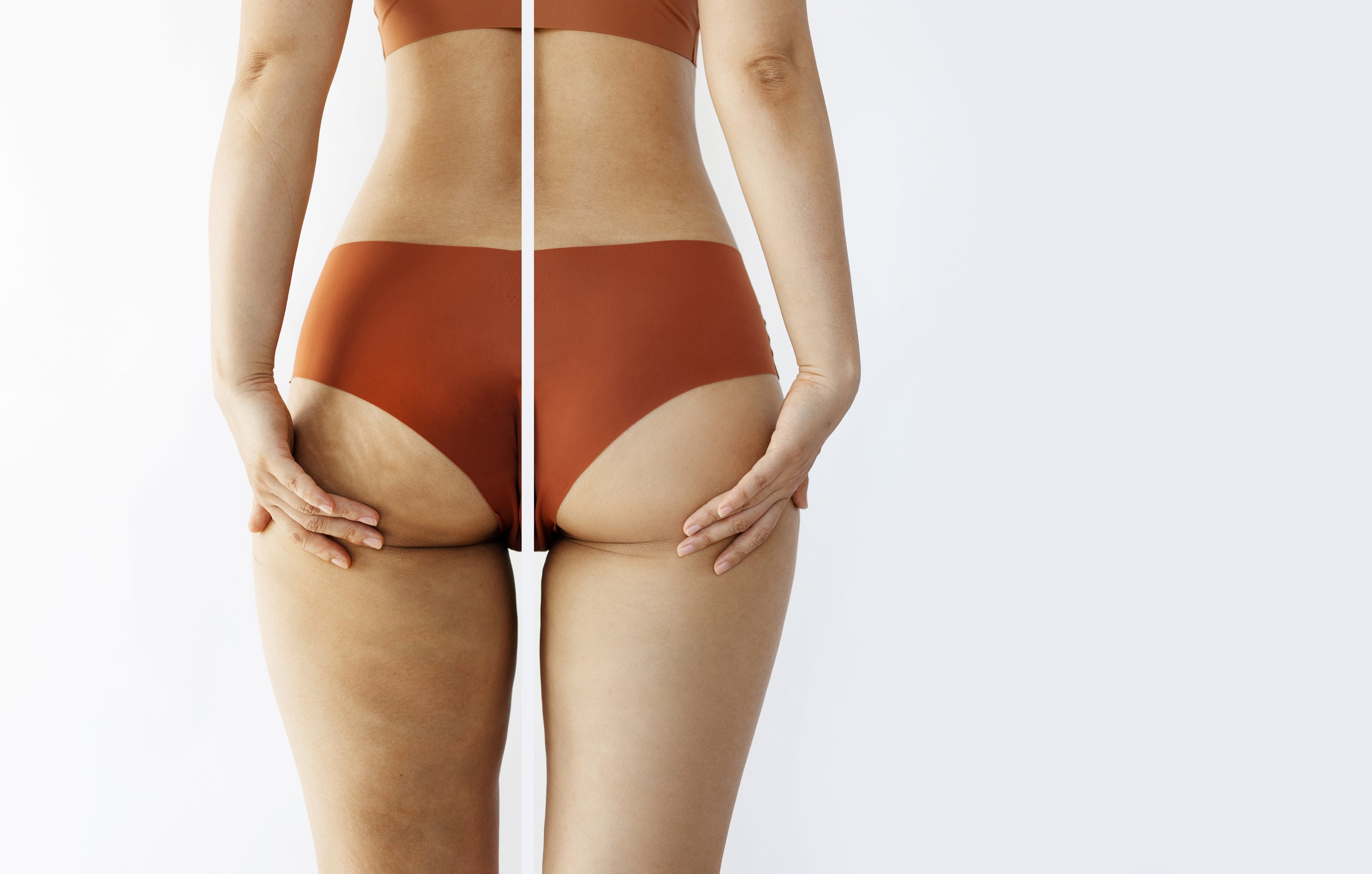 Cellulite No More